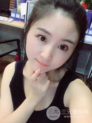 汕頭伊麗莎白孫杰醫(yī)生給我做的切開雙眼皮手術(shù)，分享一下前后對比圖片