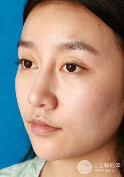 深圳源美做隆鼻失敗修復(fù)價(jià)格案例