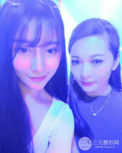 深圳源美做隆鼻失敗修復(fù)價(jià)格案例