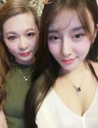 深圳源美做隆鼻失敗修復(fù)價(jià)格案例