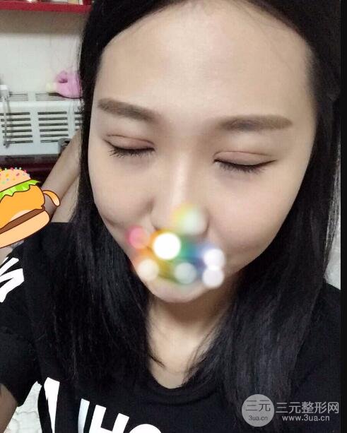 切開雙眼皮無疤痕增生果好圖片案例分享