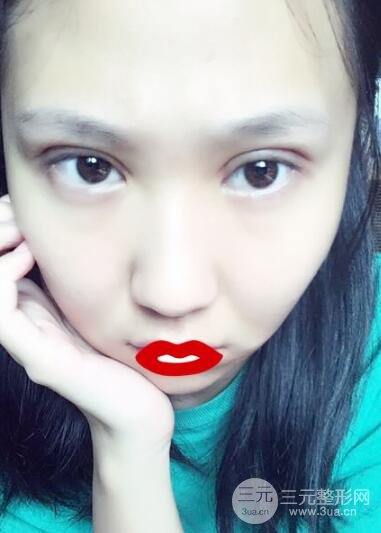 切開雙眼皮無疤痕增生果好圖片案例分享