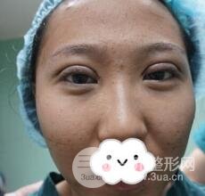 切開(kāi)雙眼皮無(wú)疤痕增生果好圖片案例分享