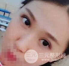 切開(kāi)雙眼皮無(wú)疤痕增生果好圖片案例分享