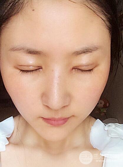 單眼皮割雙眼皮成功案例圖片