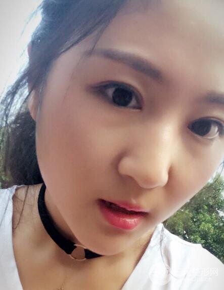 單眼皮割雙眼皮成功案例圖片