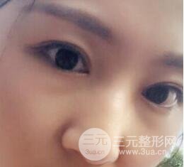 單眼皮割雙眼皮成功案例圖片
