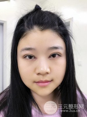 切開雙眼皮+開內(nèi)眼角真實案例，并附上前后對比圖片