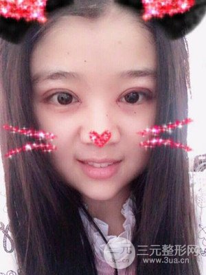 切開雙眼皮+開內(nèi)眼角真實案例，并附上前后對比圖片