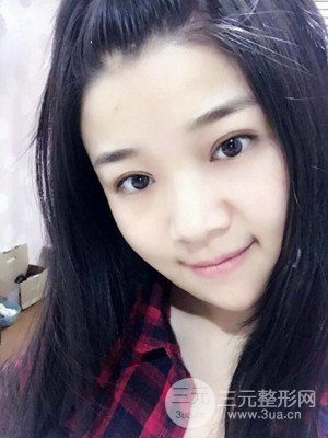 切開雙眼皮+開內(nèi)眼角真實案例，并附上前后對比圖片