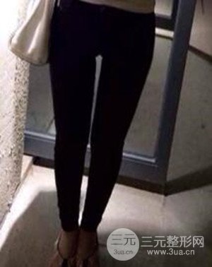 大腿抽脂案例 大腿抽脂前后對比圖