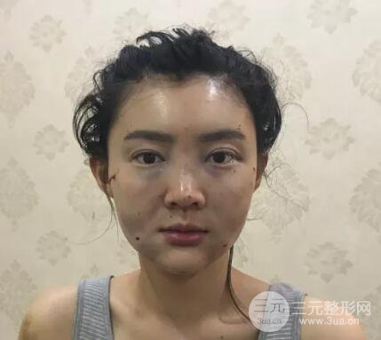 脂肪填充全臉恢復(fù)過(guò)程圖