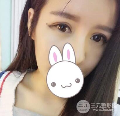 割雙眼皮失敗變幾層眼皮成功修復(fù)價(jià)格和案例分享