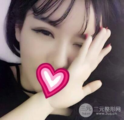 割雙眼皮失敗變幾層眼皮成功修復(fù)價(jià)格和案例分享