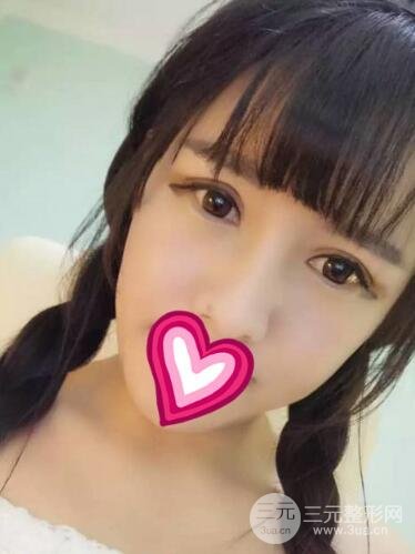 割雙眼皮失敗變幾層眼皮成功修復(fù)價(jià)格和案例分享