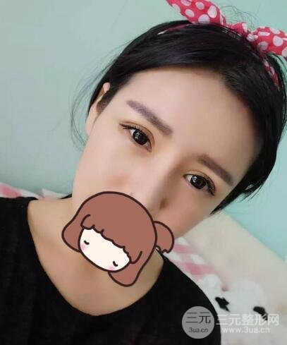 割雙眼皮失敗變幾層眼皮成功修復(fù)價(jià)格和案例分享