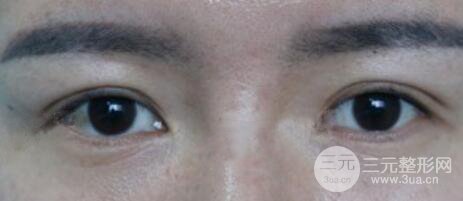 割雙眼皮失敗變幾層眼皮成功修復(fù)價(jià)格和案例分享