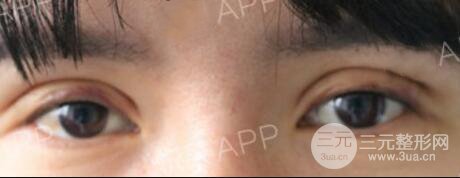 割雙眼皮失敗變幾層眼皮成功修復(fù)價(jià)格和案例分享