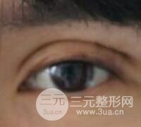 割雙眼皮失敗變幾層眼皮成功修復價格和案例分享