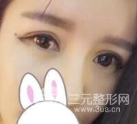 割雙眼皮失敗變幾層眼皮成功修復價格和案例分享