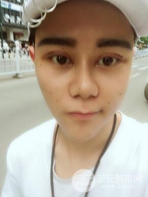 切開雙眼皮+自體脂肪填充全臉真實(shí)案例分享，并附上前后對比圖片~