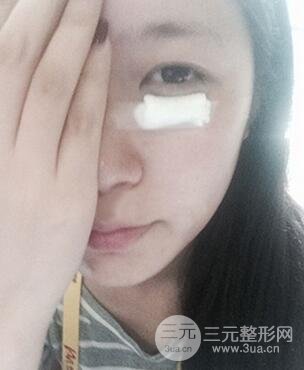 內(nèi)切祛眼袋手術(shù)真實(shí)案例，并附上前后對比圖片