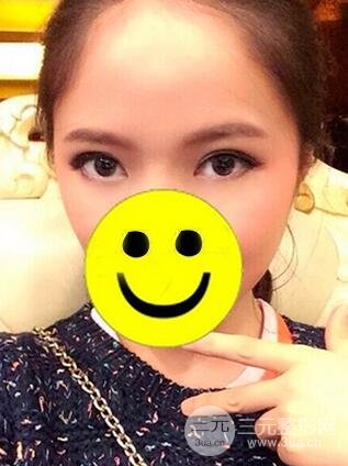 內(nèi)切祛眼袋手術(shù)真實(shí)案例，并附上前后對比圖片