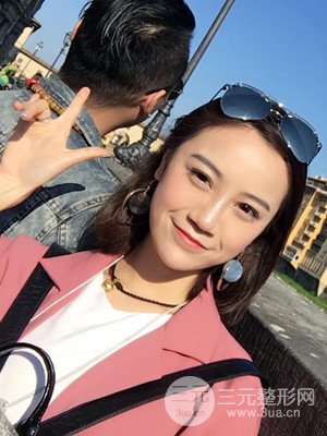 假體隆鼻+耳軟骨墊鼻尖真實案例，并附上前后對比圖~