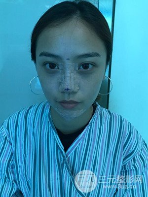 假體隆鼻+耳軟骨墊鼻尖真實案例，并附上前后對比圖~