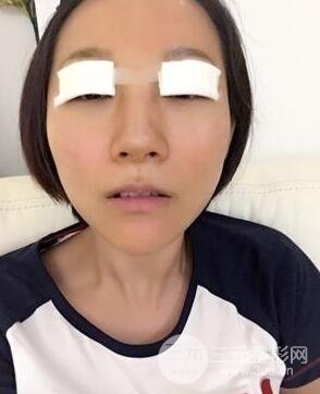 武漢葉子竺湘云給我做的切開雙眼皮手術(shù)，分享一下前后對(duì)比圖片