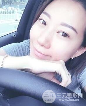 武漢葉子竺湘云給我做的切開雙眼皮手術(shù)，分享一下前后對(duì)比圖片