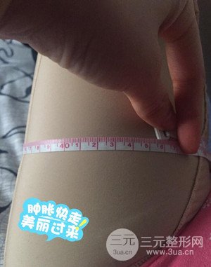 大腿吸脂前后對(duì)比圖以及恢復(fù)過程分享——武漢葉子竺湘云醫(yī)生做的