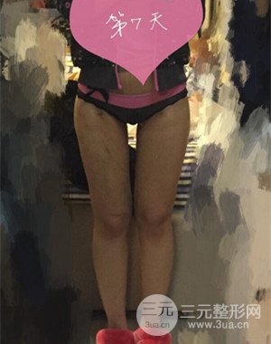 大腿吸脂前后對(duì)比圖以及恢復(fù)過程分享——武漢葉子竺湘云醫(yī)生做的