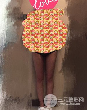 大腿吸脂前后對(duì)比圖以及恢復(fù)過程分享——武漢葉子竺湘云醫(yī)生做的