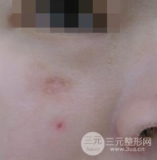 激光祛疤非手術真實果圖案例