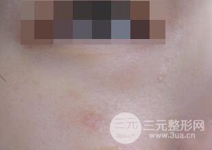 激光祛疤非手術真實果圖案例