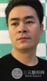 男士高強度聚焦超聲面b提升微整形真實案例