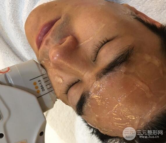 男士高強度聚焦超聲面b提升微整形真實案例