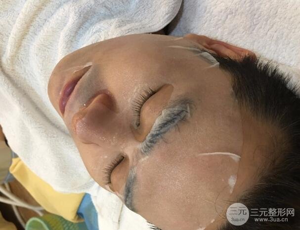 男士高強度聚焦超聲面b提升微整形真實案例