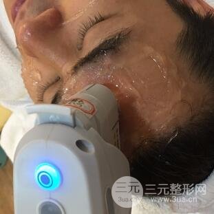 男士高強度聚焦超聲面b提升微整形真實案例