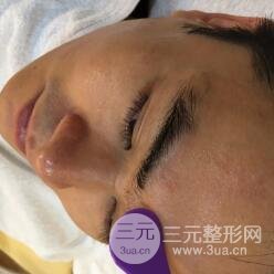 男士高強度聚焦超聲面b提升微整形真實案例