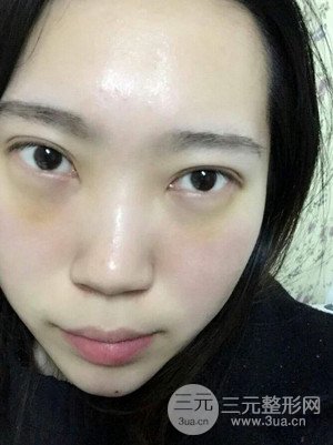 內(nèi)切祛眼袋手術(shù)真實案例，武漢天申胡麗醫(yī)生做的