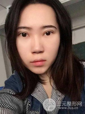 內(nèi)切祛眼袋手術(shù)真實案例，武漢天申胡麗醫(yī)生做的