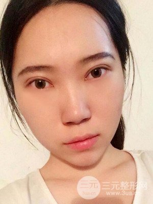 內(nèi)切祛眼袋手術(shù)真實案例，武漢天申胡麗醫(yī)生做的