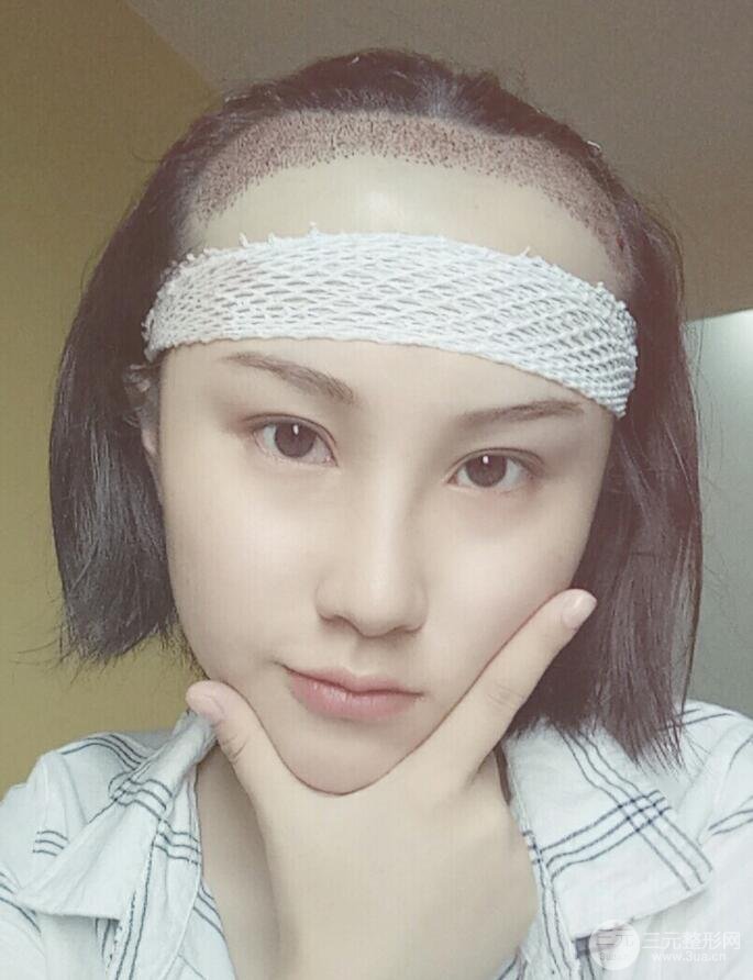 武漢天申胡麗醫(yī)生發(fā)際線種植真實案例，并附上前后對比圖片
