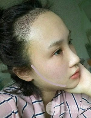武漢天申胡麗醫(yī)生發(fā)際線種植真實案例，并附上前后對比圖片
