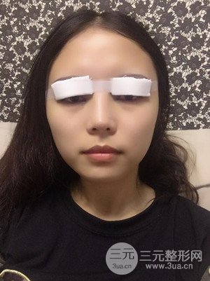 　全切雙眼皮真實(shí)案例分享，武漢一美汪國民醫(yī)生做的