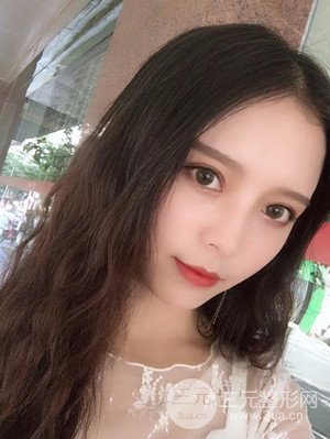 　全切雙眼皮真實(shí)案例分享，武漢一美汪國民醫(yī)生做的