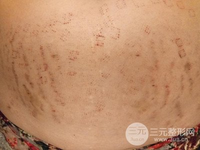 武漢一美王朝暉激光去妊娠紋真實(shí)案例，并附上前后對比圖片