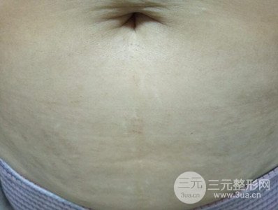 武漢一美王朝暉激光去妊娠紋真實(shí)案例，并附上前后對比圖片